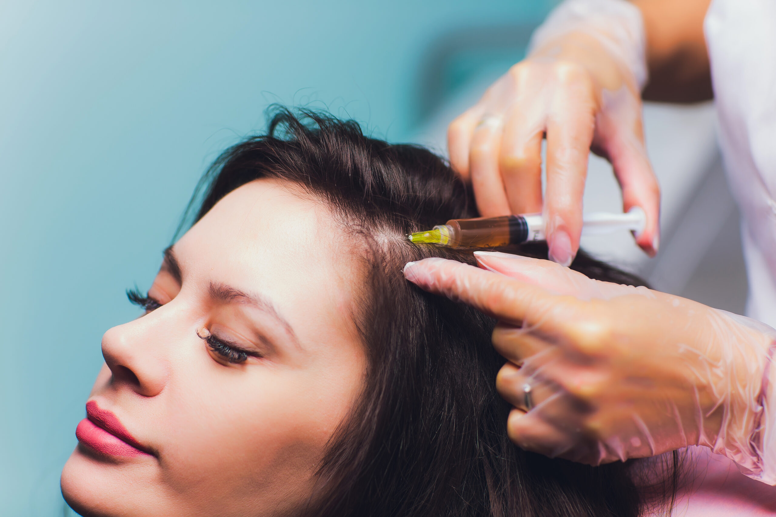 Platelet rich plasma injection procedure. Hair growth stimulation. PRP therapy process. Platelet rich plasma injection procedure. Hair growth stimulation. PRP therapy process
